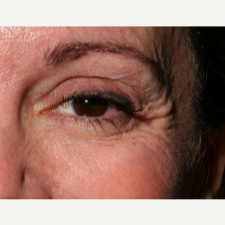 55-64 year old woman treated with Botox before 3345071