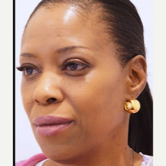 45-54 year old woman treated with Lip Augmentation after 3727592