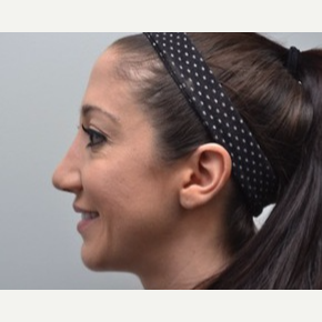 25-34 year old woman treated with Rhinoplasty after 3747750