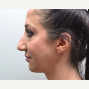 25-34 year old woman treated with Rhinoplasty before 3747750