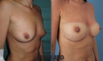 Fat transfer/silicone combination breast augmentation 1495334