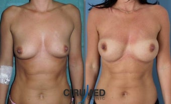 Fat transfer/silicone combination breast augmentation before 1495334