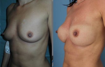Fat transfer/silicone combination breast augmentation after 1495334