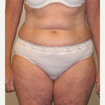55-64 year old woman treated with Tummy Tuck before 1557680