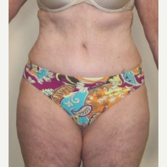 55-64 year old woman treated with Tummy Tuck after 1557680