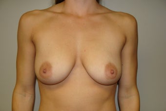 Breast Augmentation before 209897