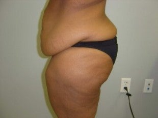 40 year old lady with excess skin after gastric bypass - side view before 621313