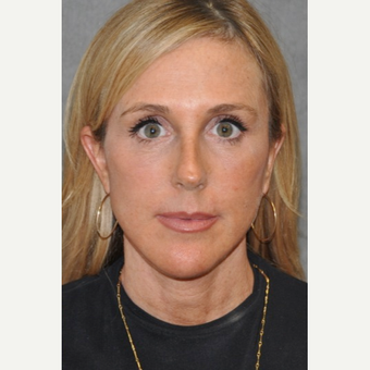 45-54 year old woman treated with Facelift after 3567137