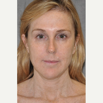 45-54 year old woman treated with Facelift before 3567137