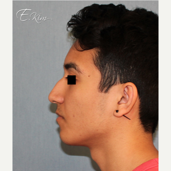 18-24 year old man treated with Rhinoplasty before 3577997