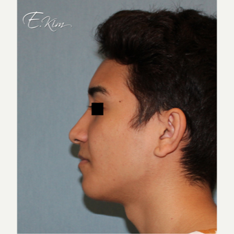 18-24 year old man treated with Rhinoplasty after 3577997