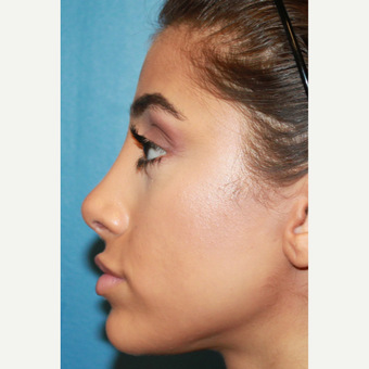 18-24 year old woman treated with Revision Rhinoplasty after 3542687