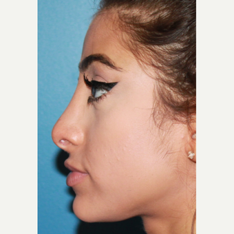 18-24 year old woman treated with Revision Rhinoplasty before 3542687