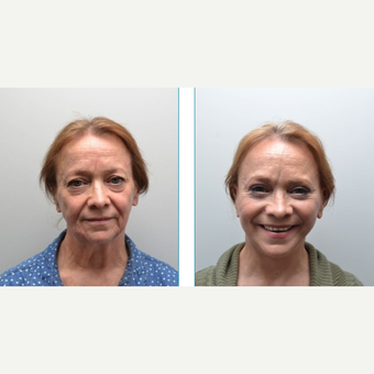 55-64 year old woman treated with Facelift after 3747635