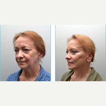 55-64 year old woman treated with Facelift before 3747635