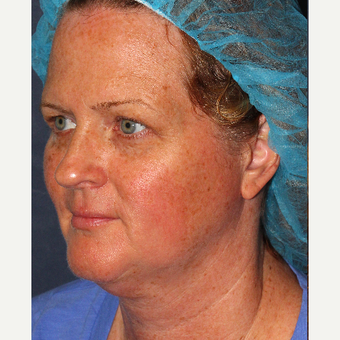 35-44 year old man treated with Fraxel Laser for sun damage removal before 3346086