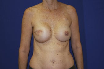 48 year old female with history of bilateral breast cancer. after 1249560
