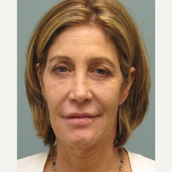 55-64 year old woman treated with Bellafill and Ultherapy before 3141702