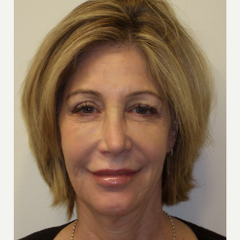55-64 year old woman treated with Bellafill and Ultherapy after 3141702