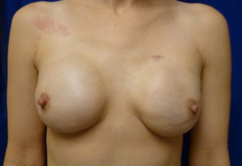 Skin Sparing Mastectomy via Inframammary Fold and Delayed Reconstruction with Expanders and Alloderm after 1263141