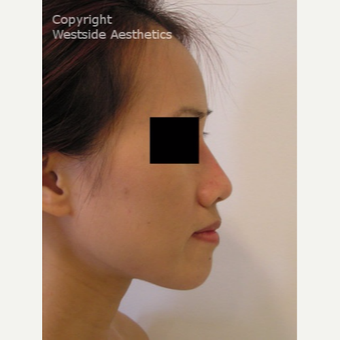 Non Surgical Nose Job Young Vietnamese Woman after 2977323