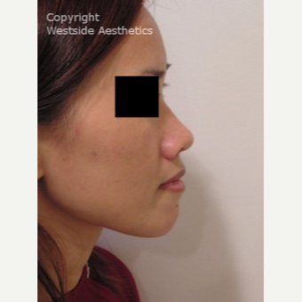 Non Surgical Nose Job Young Vietnamese Woman before 2977323
