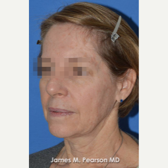 55-64 year old woman treated with Facelift before 3802282