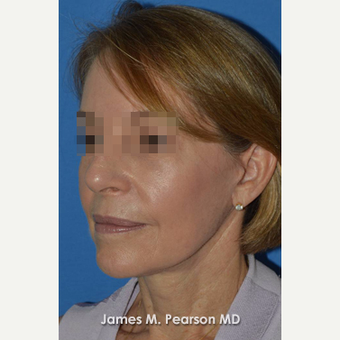 55-64 year old woman treated with Facelift after 3802282