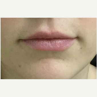 25-34 year old woman treated with Injectable Fillers after 3219568