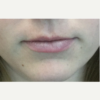 25-34 year old woman treated with Injectable Fillers before 3219568