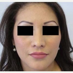 Rhinoplasty after 2993760