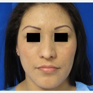 Rhinoplasty before 2993760