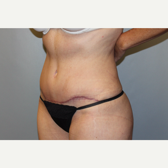 45-54 year old man treated with Tummy Tuck after 3588249