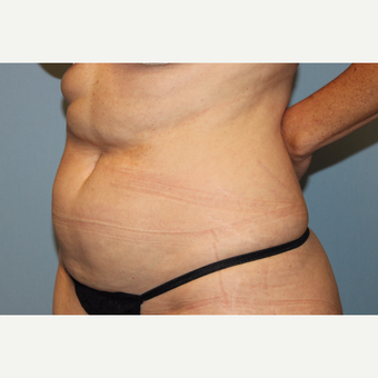 45-54 year old man treated with Tummy Tuck before 3588249