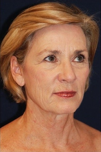 55-64 year old woman treated for SMAS Facelift before 1534570