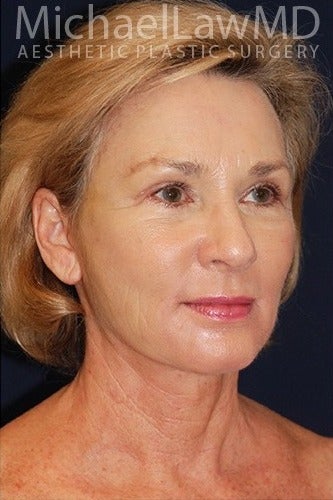 55-64 year old woman treated for SMAS Facelift after 1534570