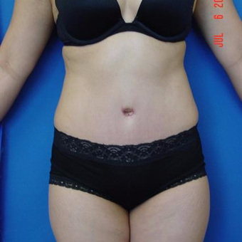45-54 year old woman treated with Tummy Tuck after 3287735
