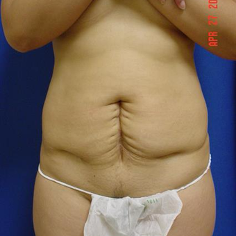 45-54 year old woman treated with Tummy Tuck before 3287735