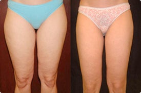 Smart Lipo: Inner Thigh Area before 989029