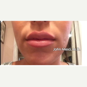 25-34 year old woman treated with Lip Augmentation after 3058430