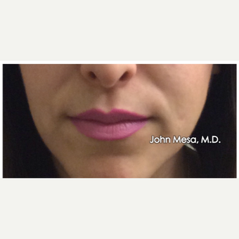 25-34 year old woman treated with Lip Augmentation before 3058430