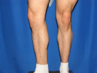 Calf Augumentation before 420865