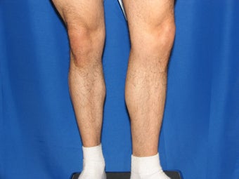 Calf Augumentation 420865