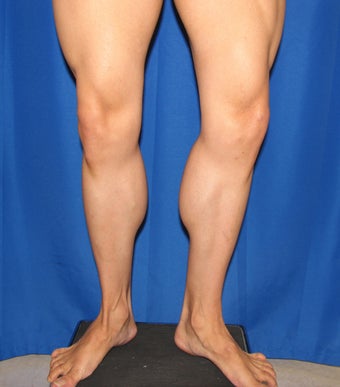 Calf Augumentation 420865