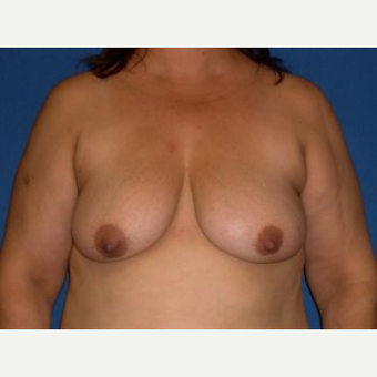 35-44 year old woman treated with Breast Lift with Implants before 3009122