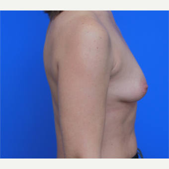 44- year old woman treated with Breast Implants before 3124400