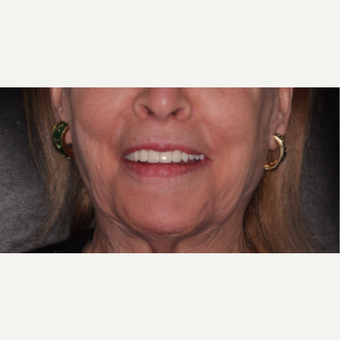 She was told she'd have to live with dentures forever after 3783292