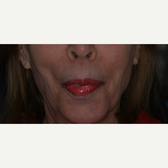 She was told she'd have to live with dentures forever before 3783292