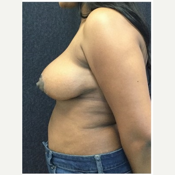 45-54 year old woman treated with Breast Reduction after 3219521