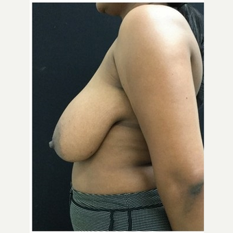 45-54 year old woman treated with Breast Reduction before 3219521